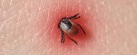 Sucking tick Macro photo on human skin